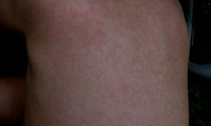 Аллергия на детский нурофен