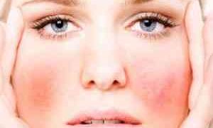 Как снять аллергический отек с лица